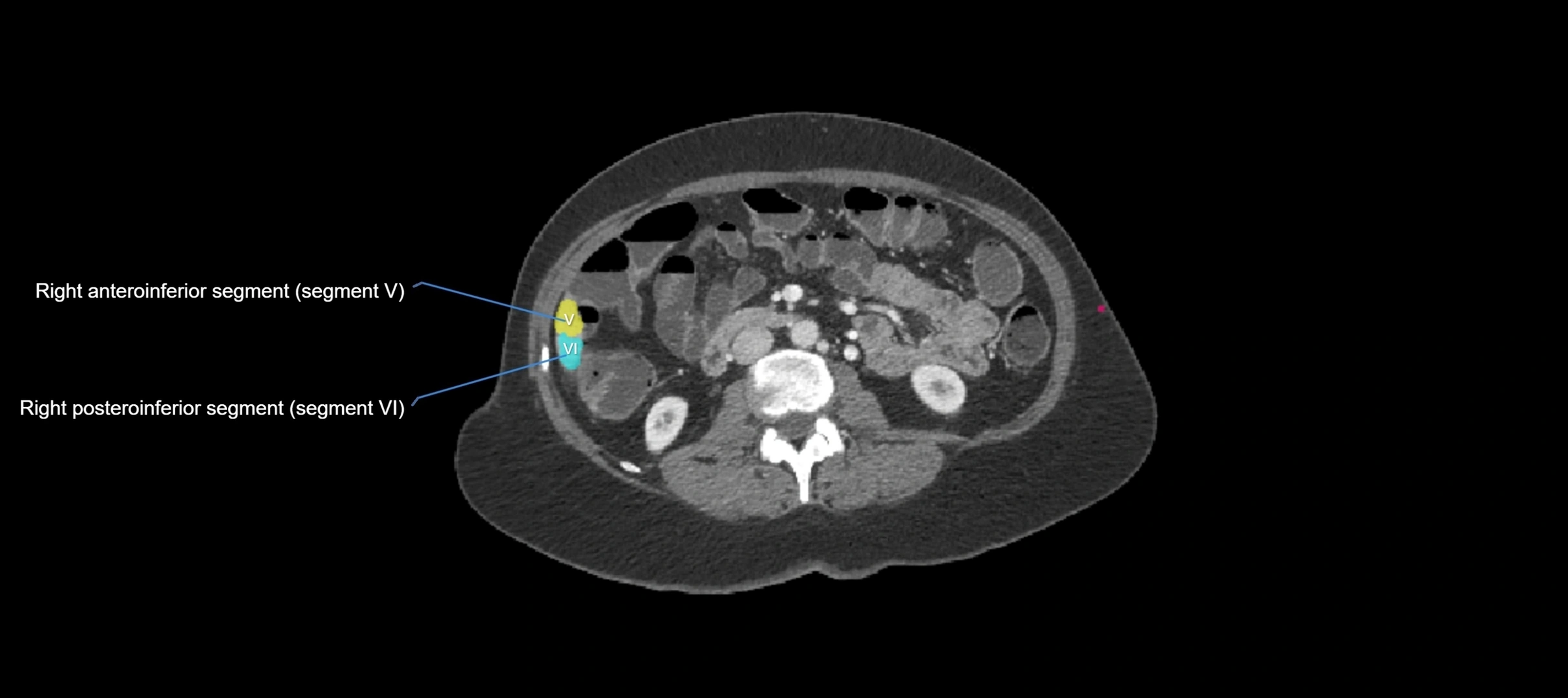 CT liver segments axial cross sectional anatomy labelled image-00004.webp